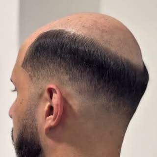 Antes e depois com uma Prótese  Capilar !