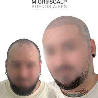 De entradas visibles a un look rapado natural 😎

✔ Resultado natural
✔ Técnica personalizada
✔ Sin 