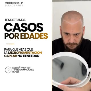 La micropigmentación capilar no tiene edad. Animate al cambio y volvé a sentir la confianza de verte
