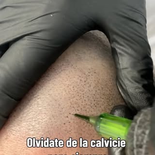 Envianos tu caso, lo evaluamos y olvidate de la calvicie para siempre 💪🏻

#calvicie #smp #micropig
