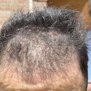 HairTransplant is not the only answer to hair loss, this guy shared with us his 6 months results. NO