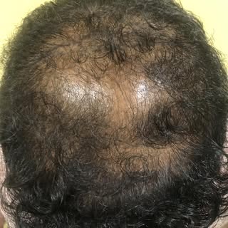 As August is hair loss awareness month, we gonna delve into detail about various causes of hair loss
