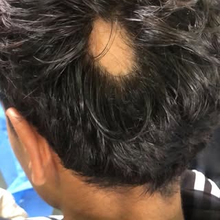 Alopecia Areata known as wal khaw in Kashmiri. 

Next leading cause of hair loss 

Cause: Disease ca