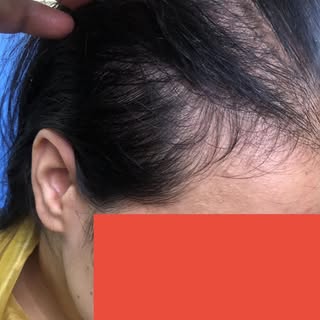 Chronic and acute Telogen Effluvium

Few months after childbirth, illness, any stressful event or su