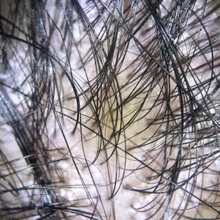 Mild degree of baldness is better than an unnatural looking hair transplant

Choose a surgeon who in