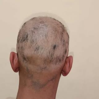 Alopecia Areata once considered most difficult to treat dermatological condition has now multiple tr
