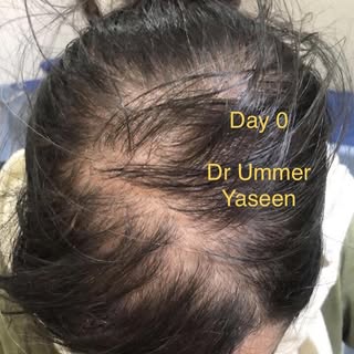 Regenerative medicine and Female pattern hair loss 

Hair loss in females is complex and multi facto