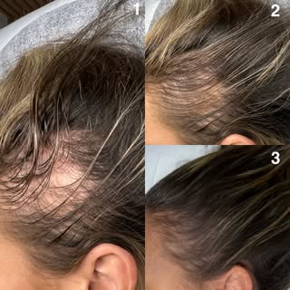 ✨ Two more sessions to go, and the transformation is already incredible!

Every scalp micropigmentat