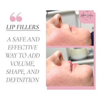 👄 Enhance your natural beauty with Lip Fillers! 👄

Lip fillers are a safe and effective way to add