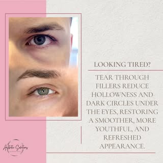👀✨ Brighten and Refresh Your Eyes with Tear Trough Filler ✨👀

If you’re looking exhausted even aft