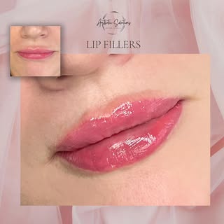 💋 Enhance your smile with beautifully balanced lips 💋
Lip fillers can give you natural-looking vol