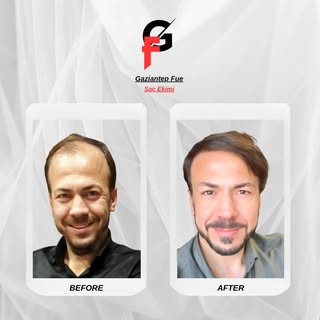 Değişimin gücüne inanın ✨Yeni bir siz, yeni bir başlangıç.

#saç #saçekimi #hair #hairtransplantturk