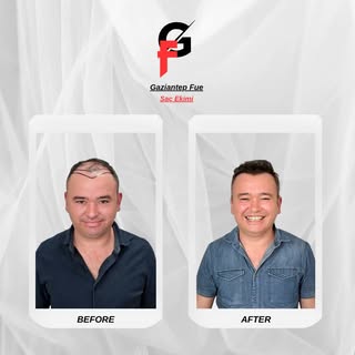 Gaziantep Fue ile Yepyeni Bir Sen: Doğal ve Kalıcı Çözüm!

#SaçEkimi #HairTransplant #GaziantepSaçEk