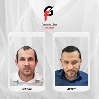 Doğal ve Kalıcı Çözüm: Saç Ekimi ile Yeniden Doğuş✨

#sacekimi #hairtransplant #gaziantepsacekimi #s