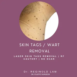 Seamless Precision. No Scars. Absolute Skin Clarity. ✨🔍
 Irregularities like warts and skin tags ca