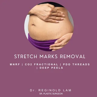 Remodel the Tissue. Fade the Markings. Smooth Your Canvas. ✨🧬
Stretch marks represent structural te