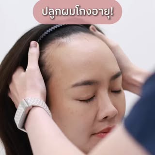 เปิด! ความลับหน้าเด็ก ปลูกผมลดอายุ กับ #หมอฝนBLS 
ปรับกรอบหน้าละมุน ลดขนาดหน้าผาก ดูเด็กลง BLS Hairl