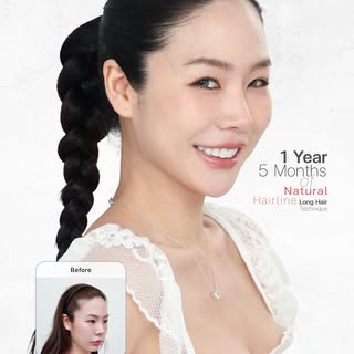 ซูมเลยชัด ๆ ความธรรมชาติของ BLS Hairline ไรผมเรียงเส้นสวย ละมุน
แก้ปัญหาเว้าหูแมว กลับมามั่นใจได้ทุก