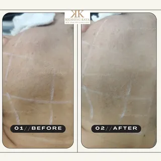 Before Laser Toning

Uneven skin tone, tanning or dull skin
Pigmentation, dark spots, freckles, mela