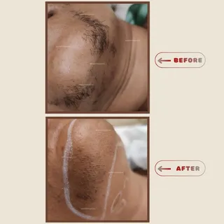 📍 Chin Laser (Laser Hair Reduction) – Before & After

At Keishing Kaya Skin Clinic

🔹 Before Treat