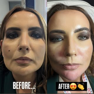 Softening lines, restoring confidence ✨

This combined treatment targets both nasolabial folds and m