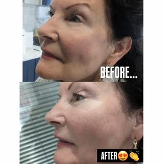 Say goodbye to deep smile lines ✨

Nasolabial fold treatment restores lost volume and softens lines,