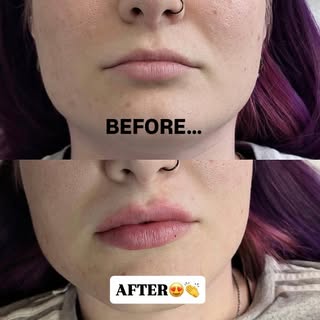 Can you believe this is only 0.5ml?! 😍

With the right product and a skilled injector, you can achi