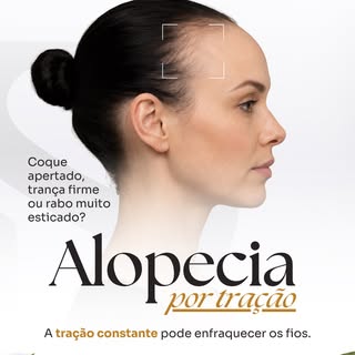 Coques muito apertados, tranças firmes e rabos de cavalo muito esticados podem parecer inofensivos, 