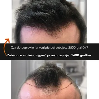 Czy do poprawienia wyglądu potrzebujesz 2500 graftów? 🤔
Zobacz co można osiągnąć przeszczepiając 14