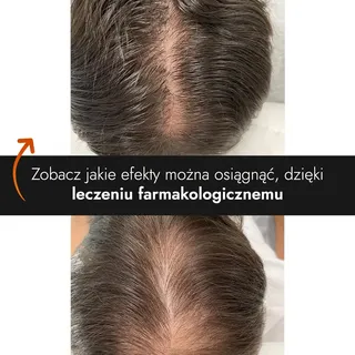 Oto kolejna metamorfoza po leczeniu farmakologicznym w Kierach Medical Clinic 🧑‍🦲👉🧑‍🦰

Problem 