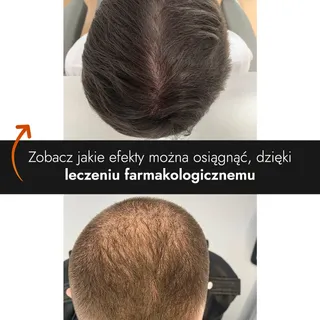 Oto kolejna metamorfoza po leczeniu farmakologicznym w Kierach Medical Clinic 🧑‍🦲👉🧑‍🦰

Problem 