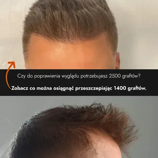 Czy do poprawienia wyglądu potrzebujesz 2500 graftów? 🤔
Zobacz co można osiągnąć przeszczepiając 14