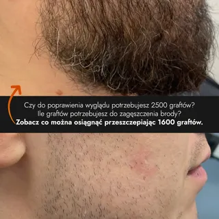 Czy do poprawienia wyglądu zarostu potrzebujesz aż 2500 graftów? 🤔
Zobacz co można osiągnąć przeszc