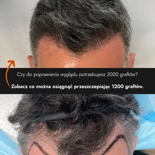 Czy do poprawienia wyglądu zarostu potrzebujesz aż 2000 graftów? 🤔
Zobacz co można osiągnąć przeszc