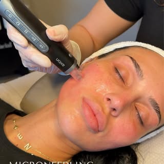 Microneedling + Exosomes ✨

Exosomes + microneedling is one of those combinations that truly earns t