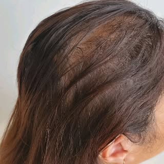 Do you feel like your Hair lacks Density or is thinning?

Scalp Micropigmentation can help by increa
