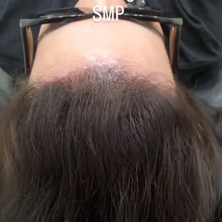 Scalp micropigmentation(SMP) is a fantastic service to camouflage scars.
After a healed procedure th