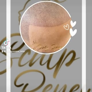 Is Scalp Micropigmentation for you?
Are you experiencing 
- hair thinning, balding, hair loss, low d