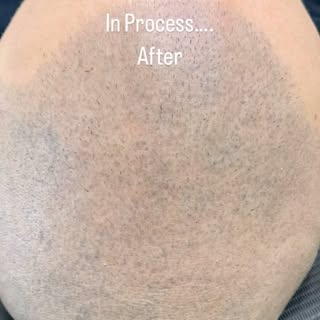 Retouch Scenario Smp retouch after 2 years  This client now finally looks complete.  He will check i