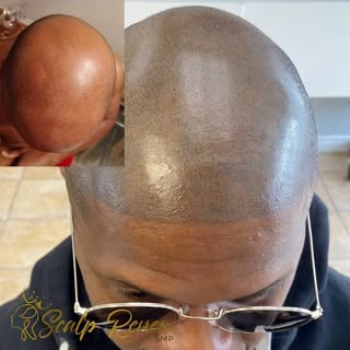 Hair loss is a thing of the past. Before and After 3 sessions of Scalp Micropigmentation #scalpmicro
