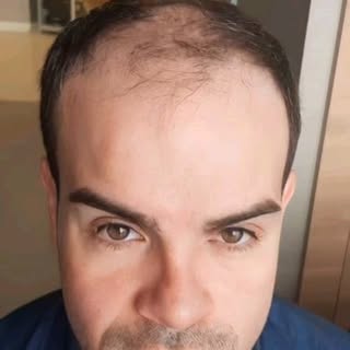 This is how we design natural looking hair line !!! 

Please contact us to get detailed information 