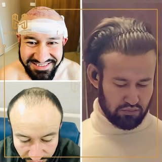 This is how we design natural looking hair line !!! 

Please contact us to get detailed information 