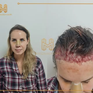 Women can also prefer hair transplantation.we adapted the front line of our patient to her face.
Ple
