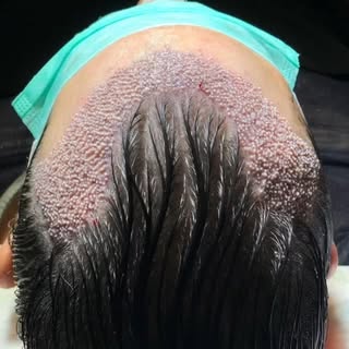 From roots to confidence: Witnessing the incredible journey of a hair transplant transformation. Emb