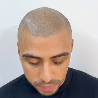 Resultados Instantáneo, ☝🏽🤩 Primera Sesion 🗣️new Hairlineink  #scalpmicropigmentation