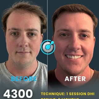 Real patient, real transformation 
This is what a well-executed DHI hair transplant looks like natur