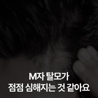 Q. M자 탈모가 점점 심해지는 것 같아요. 어떻게 해야 하나요?

A. M자 탈모는 천천히 진행되는 것 같아도
어느 순간 확 체감되는 경우가 많습니다.

중요한 건 지금 어느 단