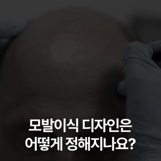 Q. 모발이식 디자인은 어떻게 정해지나요?

A. 헤어라인 디자인은 원장과 함께 정합니다.

상담 시 먼저 원하시는 방향을 충분히 듣고
얼굴형, 이마 비율, 나이, 기존 모발 방향