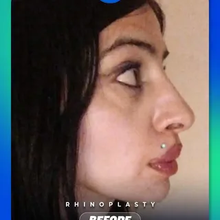 Every rhinoplasty is unique because every face is unique. 🦋

Swipe to see the transformation. 

Thi