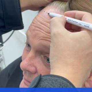A subtle change. A lasting difference. ⭐

Hair restoration is about achieving a result that looks na